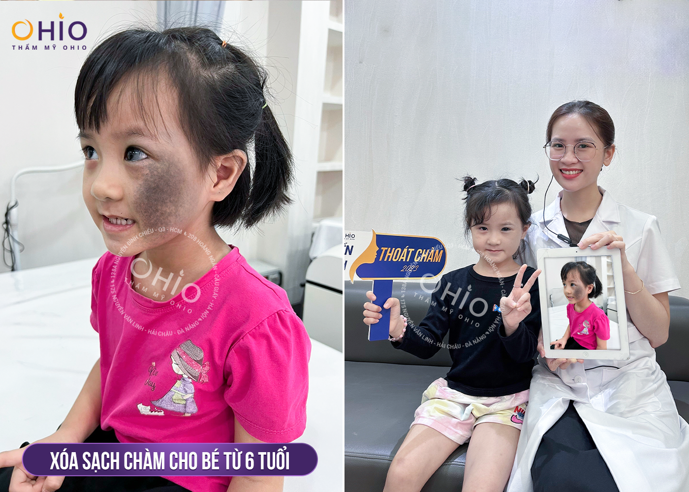 Chiến dịch Thoát chàm 2024 thực hiện hoá ước mơ cho những bệnh nhân chàm bớt sắc tố - Phòng khám da liễu OHIO Chiến dịch Thoát chàm 2024 thực hiện hoá ước mơ cho những bệnh nhân chàm bớt sắc tố