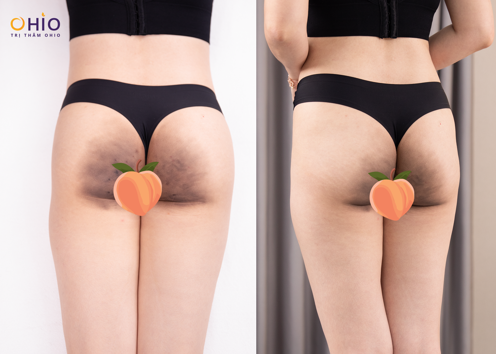 Bí quyết trị thâm mông, tự tin diện bikini của chị Hà Nhi - Phòng khám da liễu OHIO trị thâm mông cùng Hà Nhi