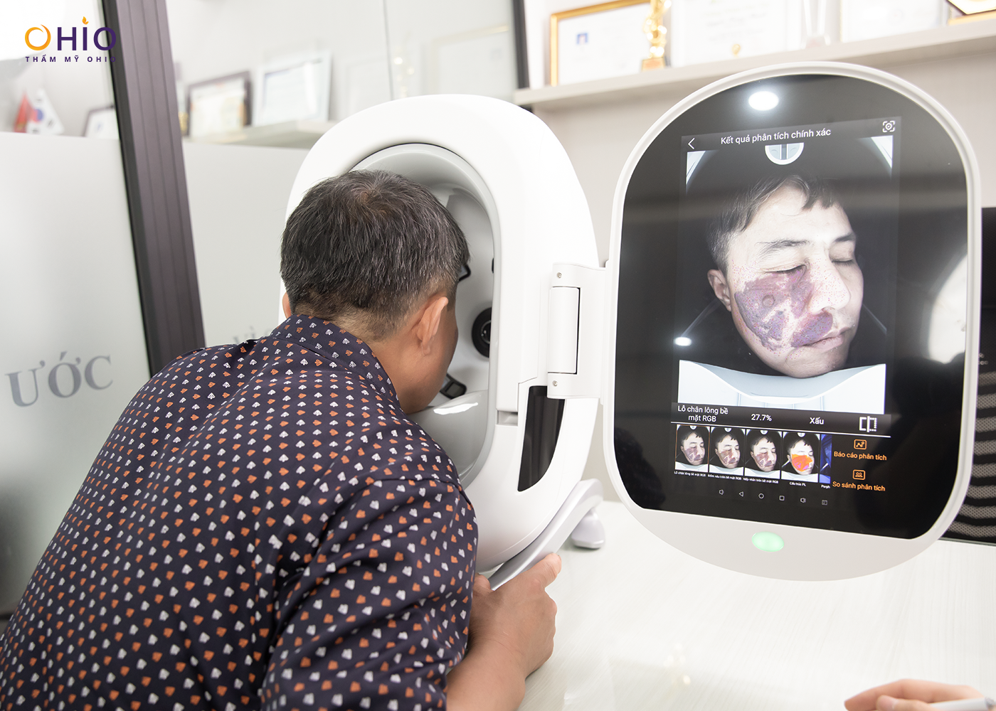 Hội chẩn Khoa học: Ứng dụng Laser trong điều trị chàm bớt sắc tố tại phòng khám OHIO - Phòng khám da liễu OHIO Hội chẩn Khoa học: Ứng dụng Laser trong điều trị chàm bớt sắc tố tại phòng khám OHIO