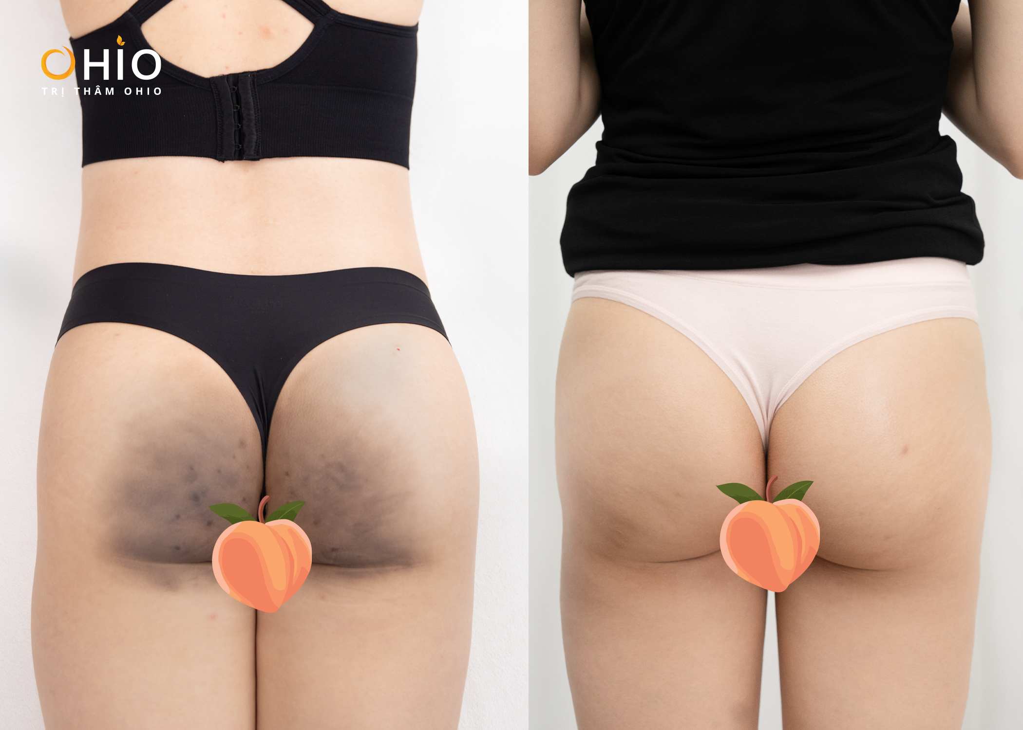 Bí quyết trị thâm mông, tự tin diện bikini của chị Hà Nhi - Phòng khám da liễu OHIO Bí quyết trị thâm mông, tự tin diện bikini của chị Hà Nhi