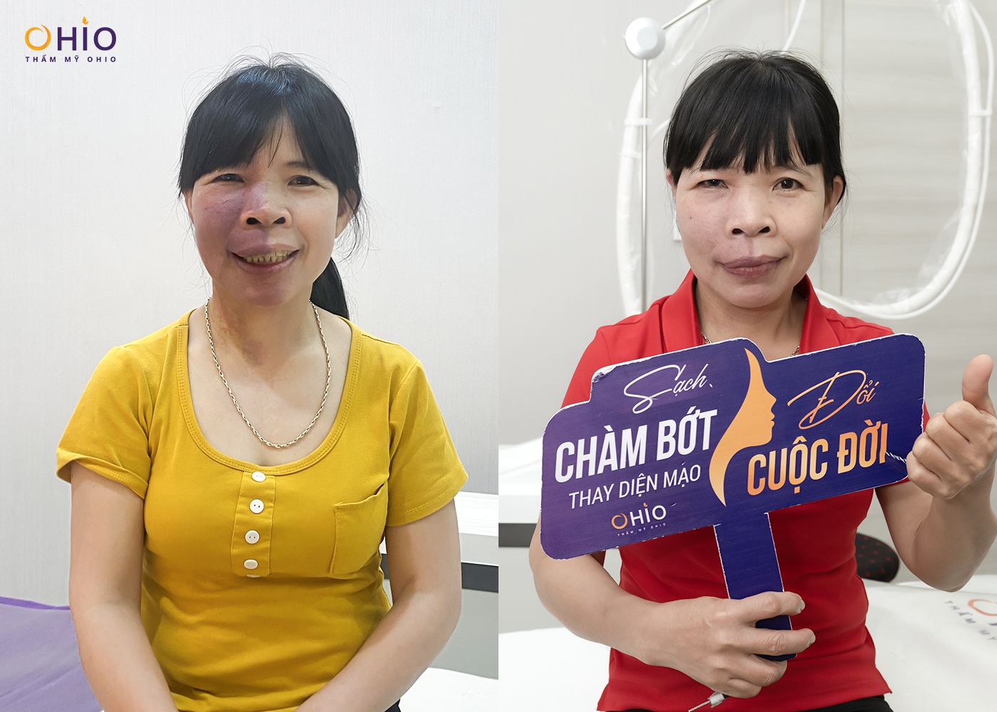 Hội chẩn Khoa học: Ứng dụng Laser trong điều trị chàm bớt sắc tố tại phòng khám OHIO - Phòng khám da liễu OHIO Hội chẩn Khoa học: Ứng dụng Laser trong điều trị chàm bớt sắc tố tại phòng khám OHIO