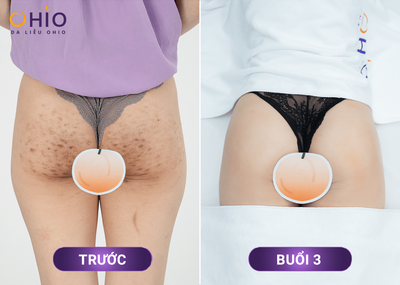 Tự tin diện bikini khoe vòng 3 trắng mịn nhờ trị thâm sần tại OHIO