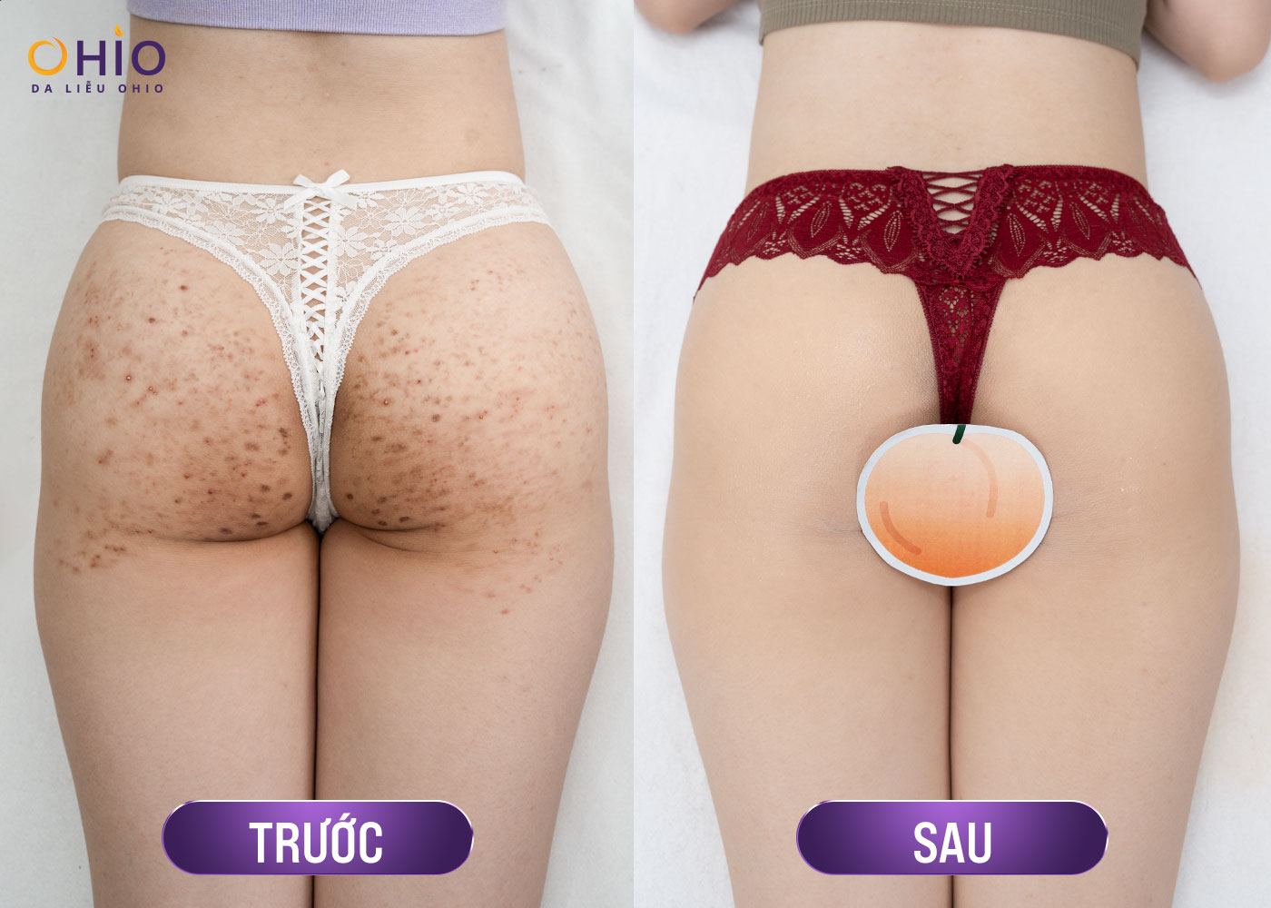 Hành trình Thoát thâm sạm của Hot girl Ngọc Anh - Phòng khám da liễu OHIO Hành trình Thoát thâm sạm của Hot girl Ngọc Anh