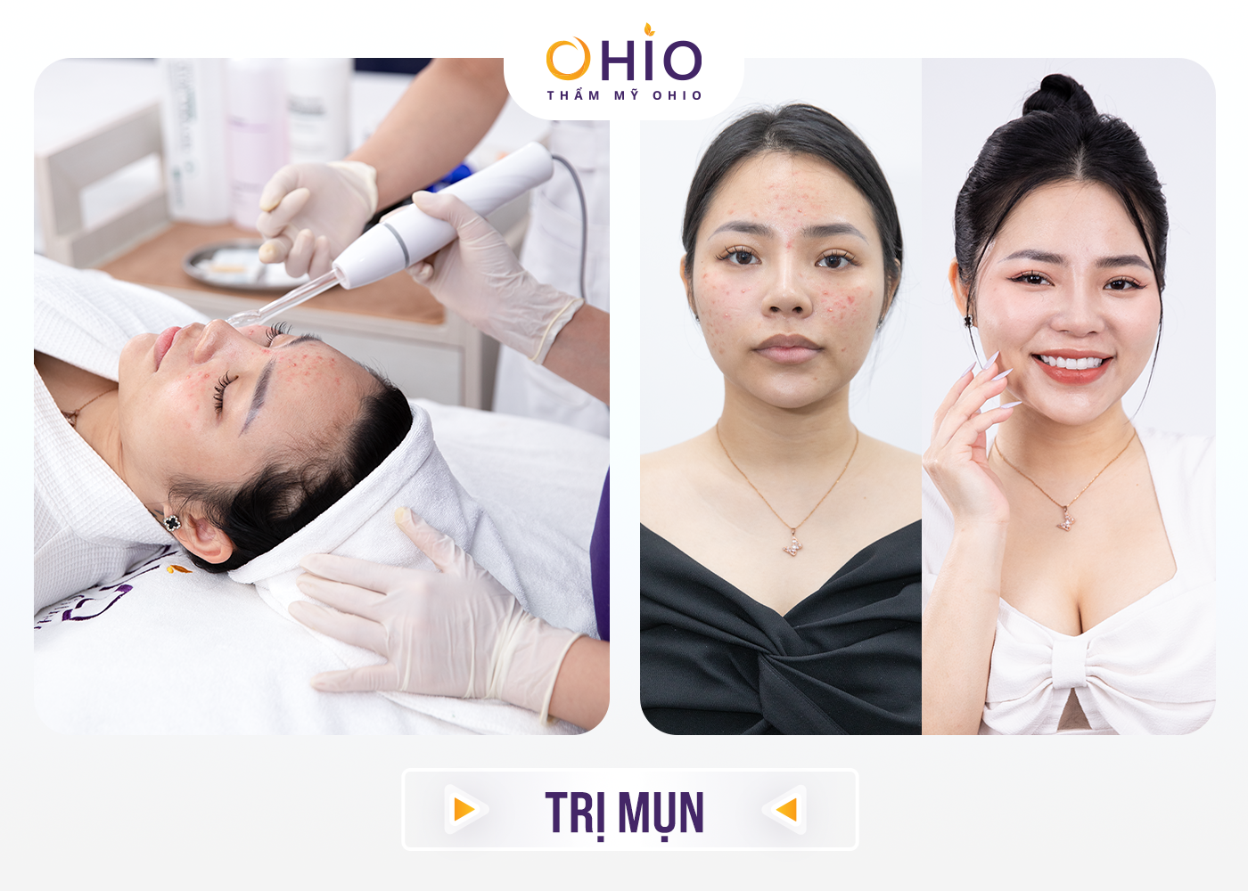 Thẩm mỹ OHIO khai trương chi nhánh thứ 4 tại Vinh, Nghệ An – Mừng hệ thống cơ sở phát triển rộng khắp 3 miền đất nước - Phòng khám da liễu OHIO Thẩm mỹ OHIO khai trương chi nhánh thứ 4 tại Vinh, Nghệ An – Mừng hệ thống cơ sở phát triển rộng khắp 3 miền đất nước