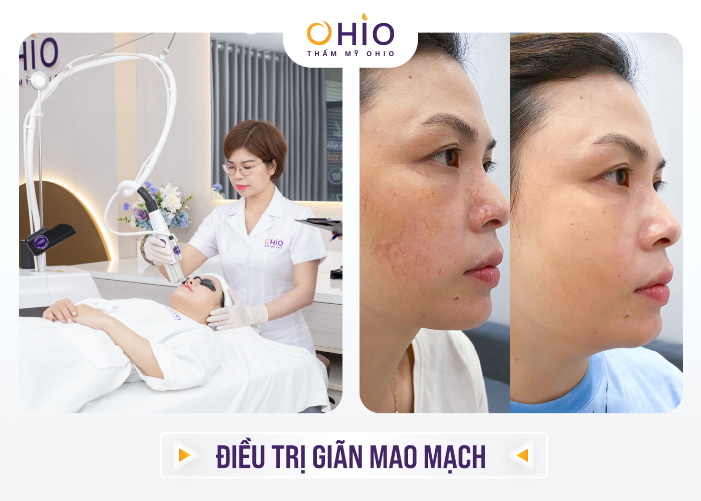Thẩm mỹ OHIO khai trương chi nhánh thứ 4 tại Vinh, Nghệ An – Mừng hệ thống cơ sở phát triển rộng khắp 3 miền đất nước - Phòng khám da liễu OHIO Thẩm mỹ OHIO khai trương chi nhánh thứ 4 tại Vinh, Nghệ An – Mừng hệ thống cơ sở phát triển rộng khắp 3 miền đất nước