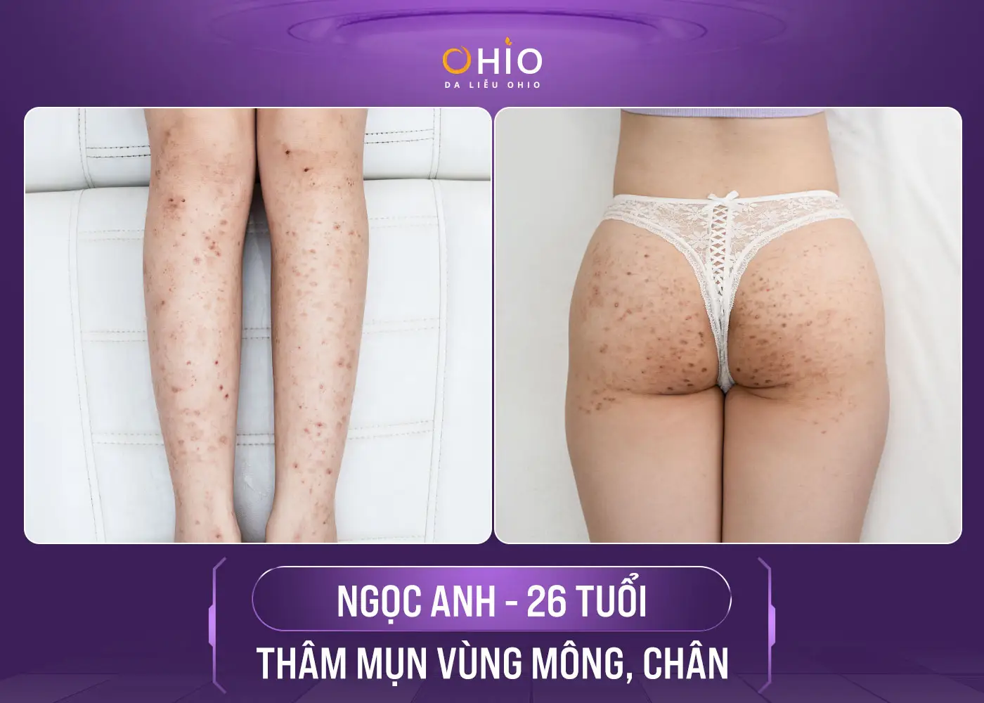 trị thâm
