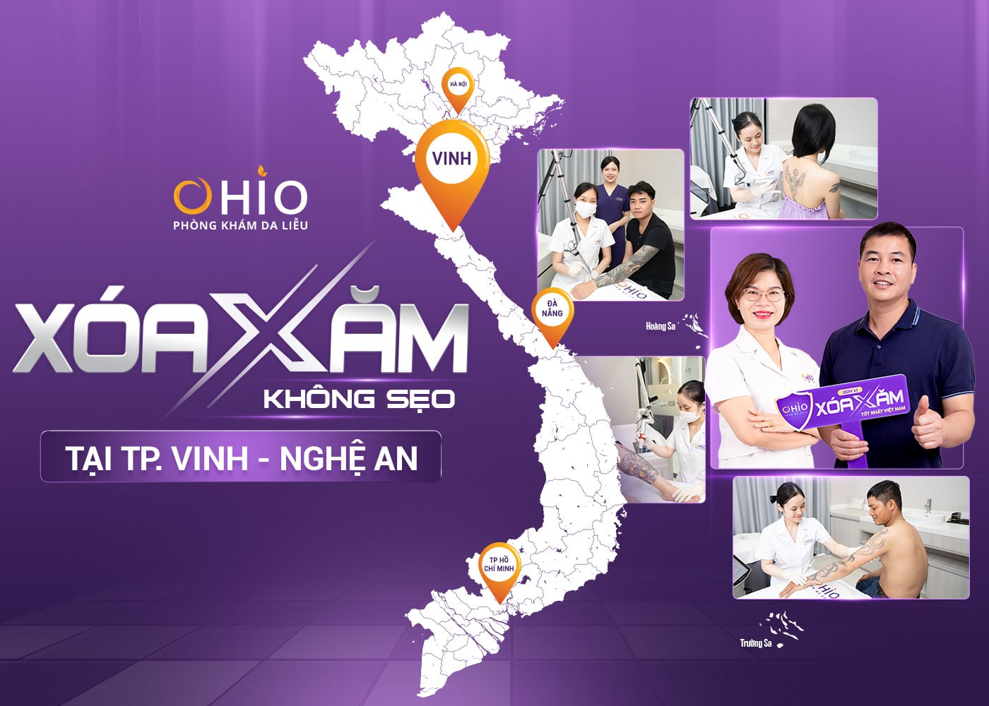 xoá xăm không đau 1 Xóa xăm không đau tại OHIO Vinh - Nghệ An