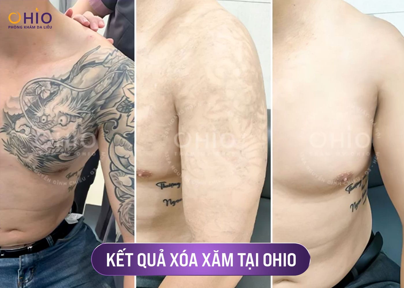xoá xăm không đau 4 Liệu trình xóa xăm không đau