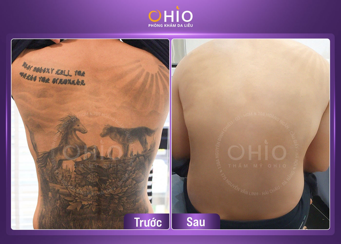 Xoá xăm an toàn, hiệu quả tại Vinh - Nghệ An - Phòng khám da liễu OHIO Khách hàng xóa xăm không đau