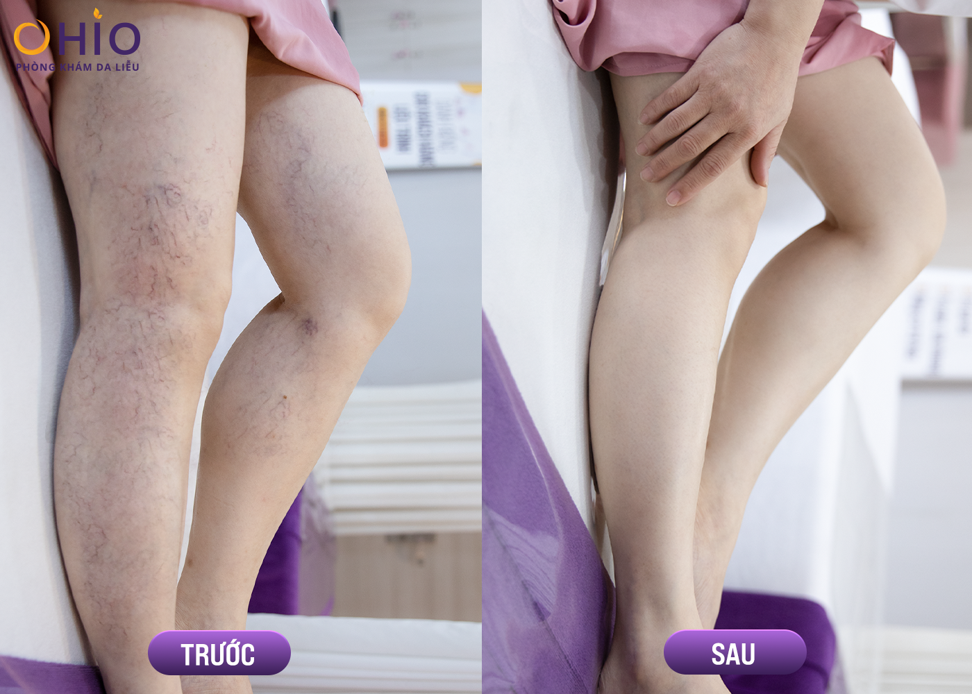 Phương pháp điều trị giãn mao mạch chi dưới hiệu quả tại Nghệ An - Phòng khám da liễu OHIO Phương pháp điều trị giãn mao mạch chi dưới hiệu quả tại Nghệ An