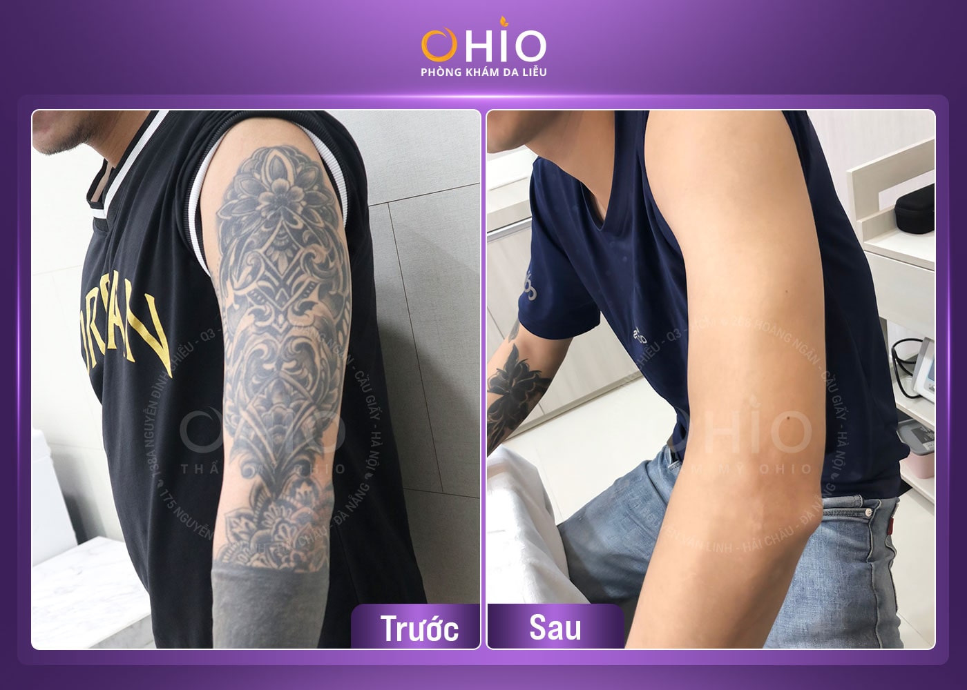 Xoá xăm an toàn, hiệu quả tại Vinh - Nghệ An - Phòng khám da liễu OHIO Khách hàng xóa xăm không đau