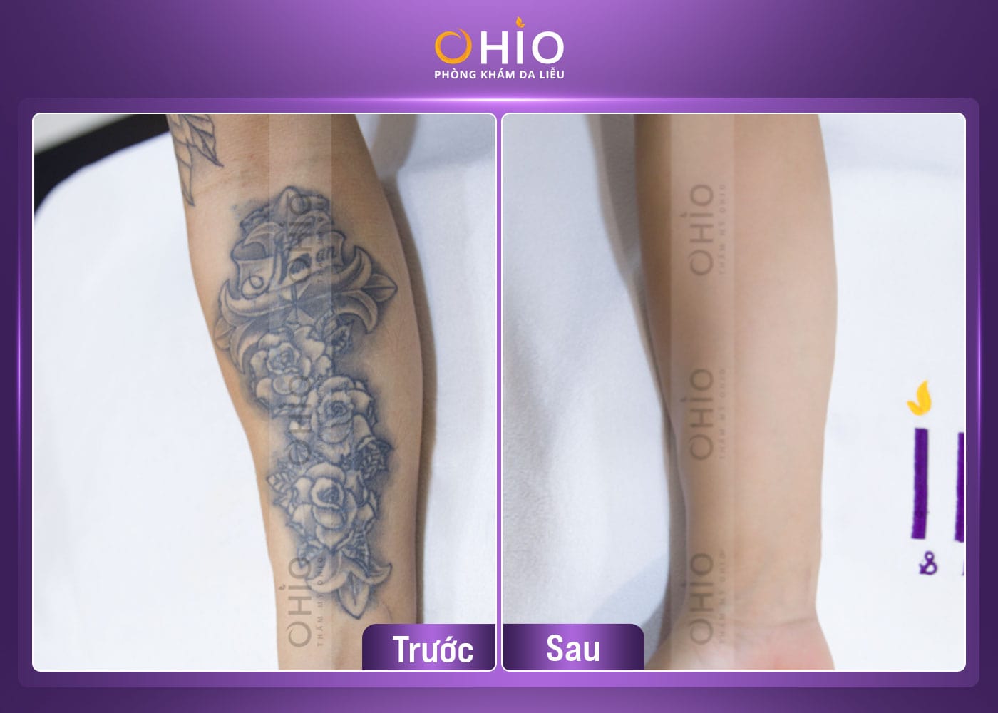 Xoá xăm an toàn, hiệu quả tại Vinh - Nghệ An - Phòng khám da liễu OHIO Khách hàng xóa xăm không đau