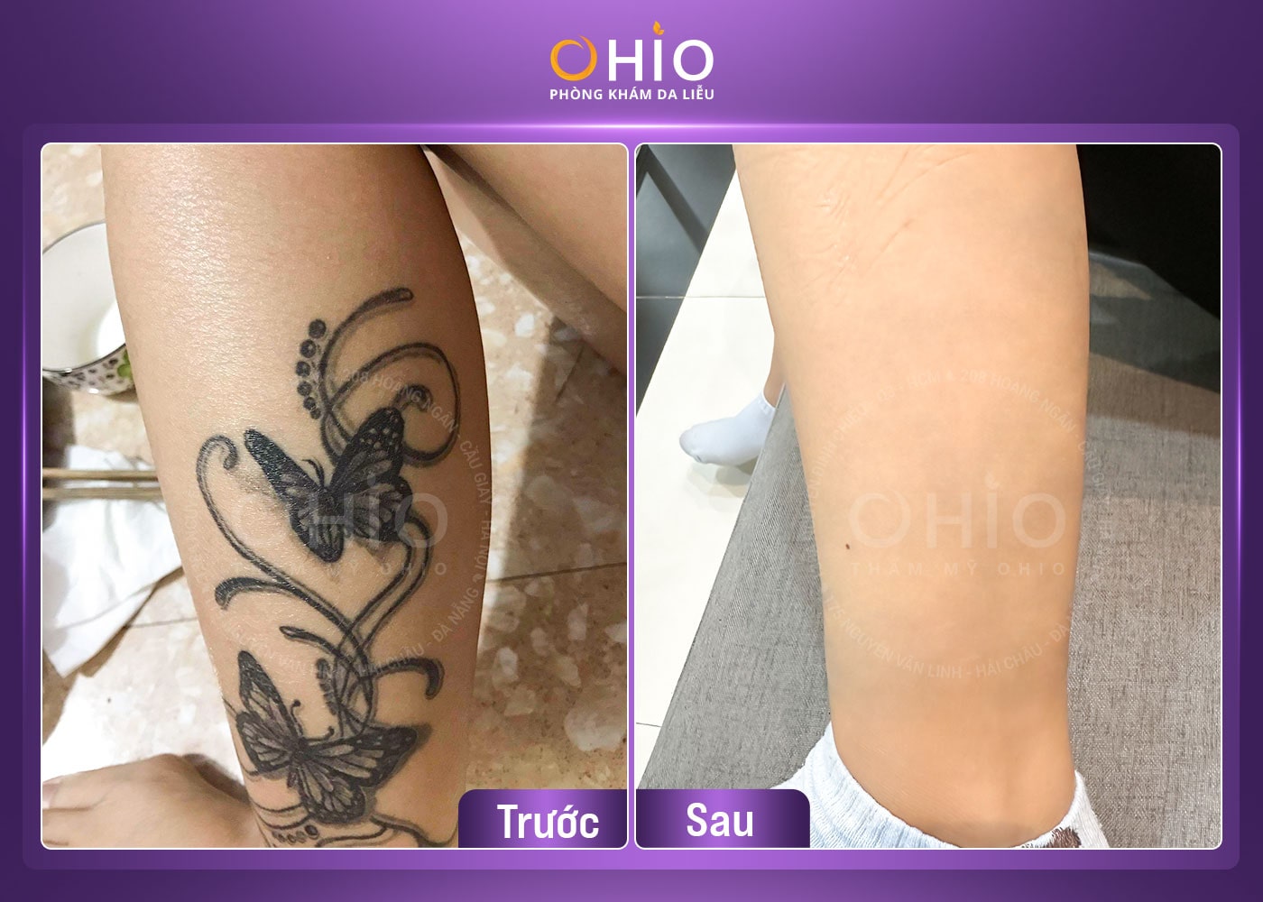 Xoá xăm an toàn, hiệu quả tại Vinh - Nghệ An - Phòng khám da liễu OHIO Khách hàng xóa xăm không đau