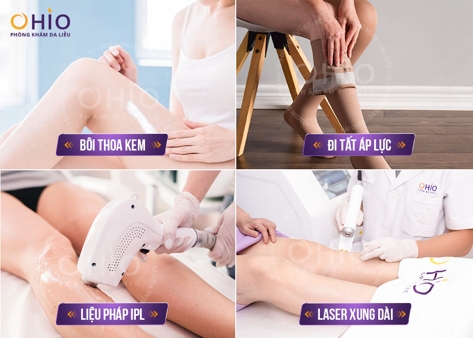 Giãn mao mạch chi dưới và cách điều trị hiệu quả tại Vinh, Nghệ An - Phòng khám da liễu OHIO Phương pháp trị giãn mao mạch chi dưới