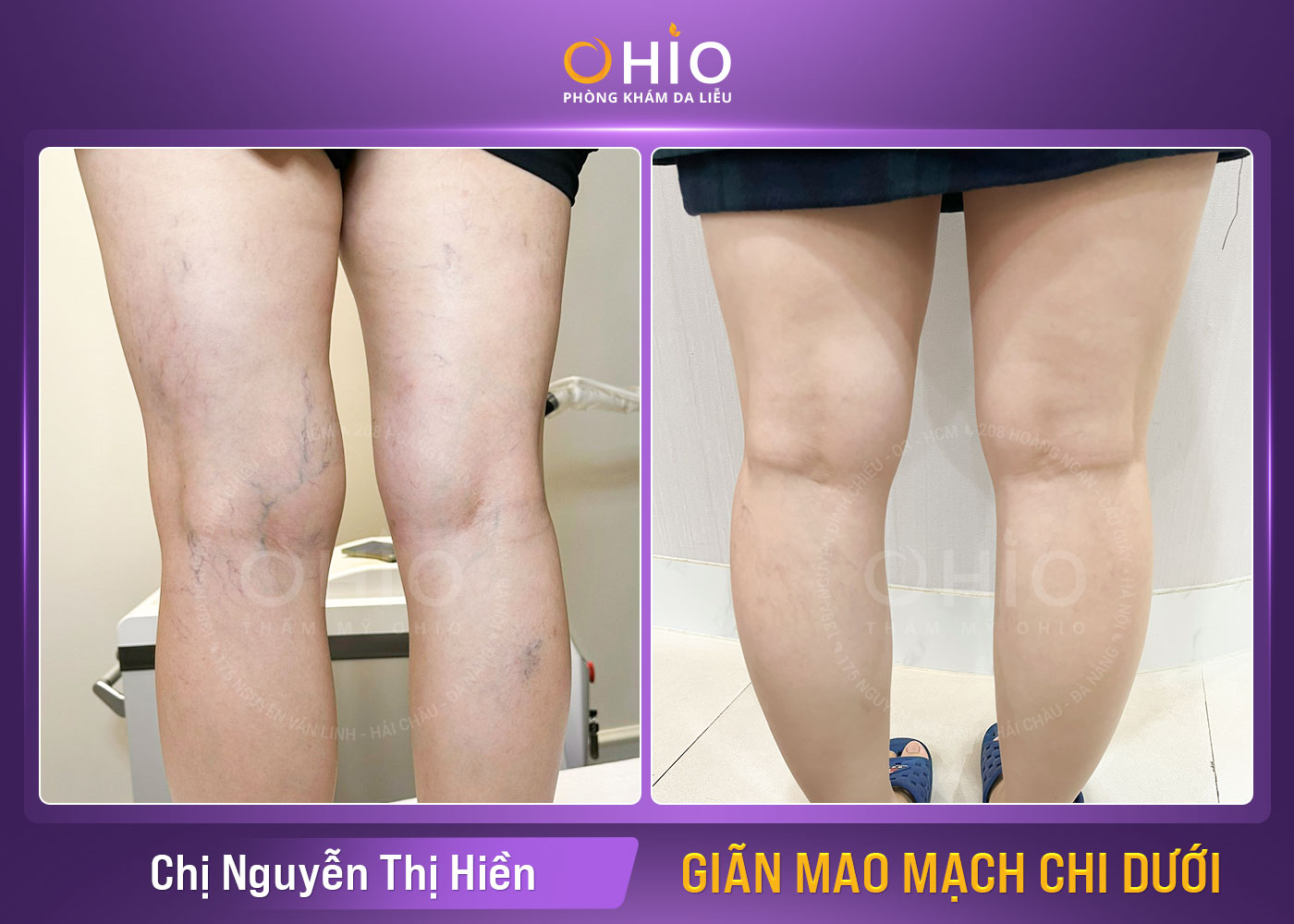 Giãn mao mạch chi dưới và cách điều trị hiệu quả tại Vinh, Nghệ An - Phòng khám da liễu OHIO Chị Nguyễn Thị Hiền- Giãn mao mạch chi dưới