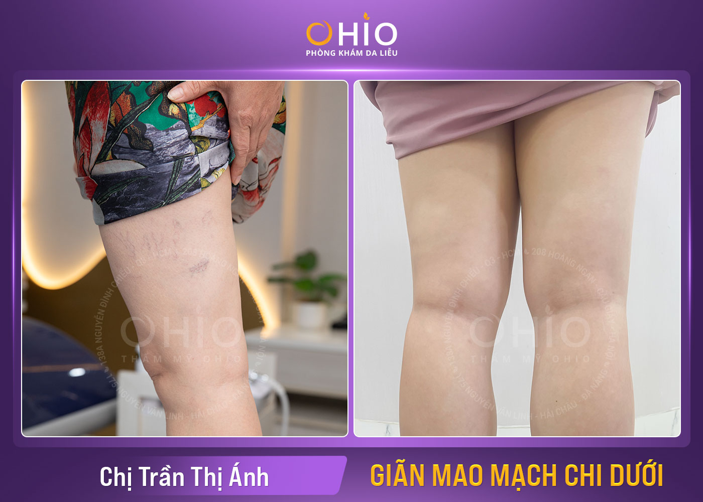 Giãn mao mạch chi dưới và cách điều trị hiệu quả tại Vinh, Nghệ An - Phòng khám da liễu OHIO Chị Trần Thị Ánh - Giãn mao mạch chi dưới