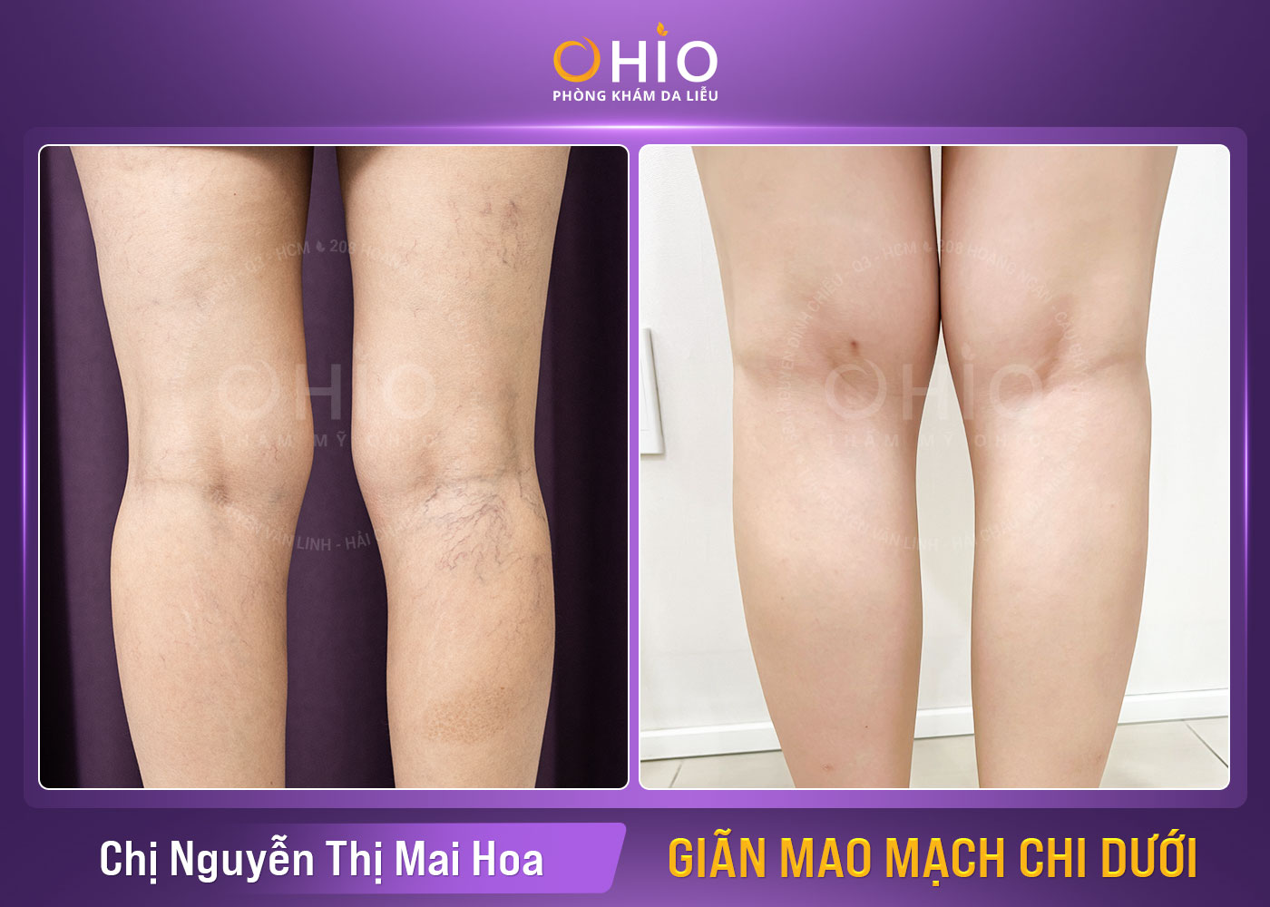 Giãn mao mạch chi dưới và cách điều trị hiệu quả tại Vinh, Nghệ An - Phòng khám da liễu OHIO Chị Nguyễn Thị Mai Hoa - Giãn mao mạch chi dưới