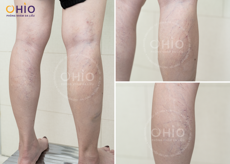 Trị giãn mao mạch Tổ hợp laser xung dài - An toàn, hiệu quả - Phòng khám da liễu OHIO Trị giãn mao mạch Tổ hợp laser xung dài - An toàn, hiệu quả