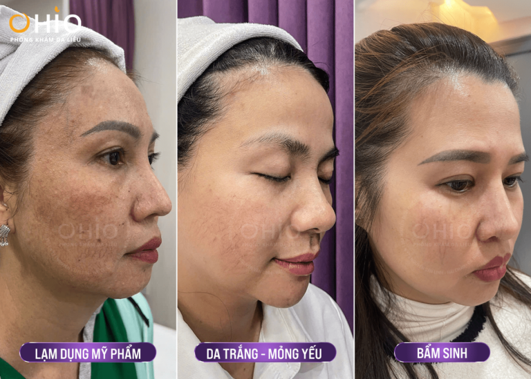 Trị giãn mao mạch Tổ hợp laser xung dài - An toàn, hiệu quả - Phòng khám da liễu OHIO Trị giãn mao mạch Tổ hợp laser xung dài - An toàn, hiệu quả