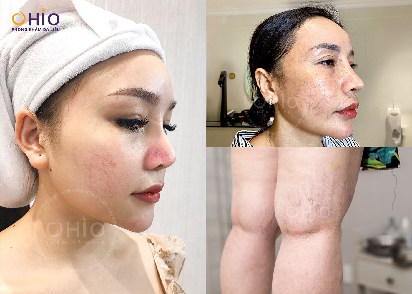 Trị giãn mao mạch Tổ hợp laser xung dài - An toàn, hiệu quả - Phòng khám da liễu OHIO trị giãn mao mạch