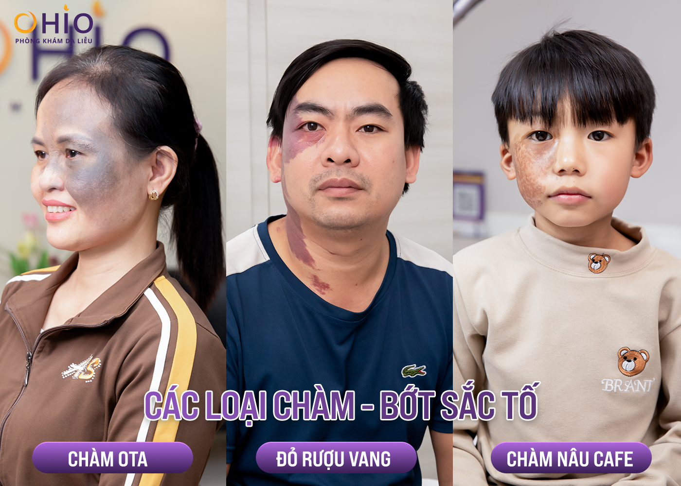 Xóa chàm bớt hiệu quả tại Nghệ An - Phòng khám da liễu OHIO xoá chàm bớt hiệu quả