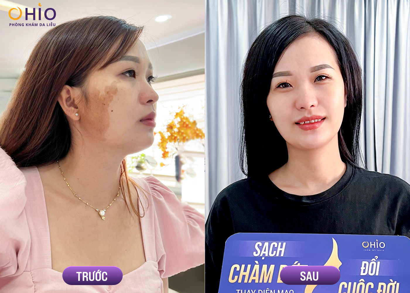 Xóa chàm bớt hiệu quả tại Nghệ An - Phòng khám da liễu OHIO Xóa chàm bớt hiệu quả tại Nghệ An