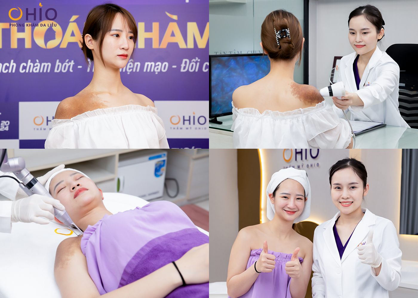 Xóa chàm bớt hiệu quả tại Nghệ An - Phòng khám da liễu OHIO Xóa chàm bớt hiệu quả tại Nghệ An