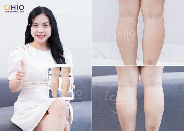 Trị giãn mao mạch Tổ hợp laser xung dài - An toàn, hiệu quả - Phòng khám da liễu OHIO Trị giãn mao mạch Tổ hợp laser xung dài - An toàn, hiệu quả