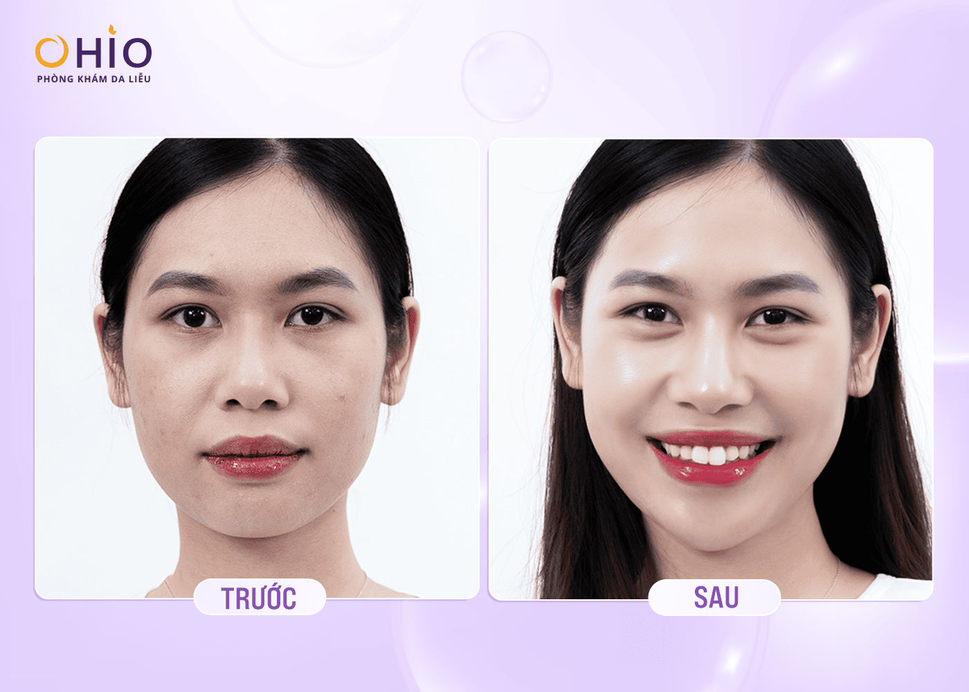 Phác Đồ Trẻ Hóa Da Đa Điểm Reborn Lift - Tái Sinh Nguyên Bào Thế Hệ Mới - Phòng khám da liễu OHIO phác đồ siêu trẻ hoá da Reborn Lift