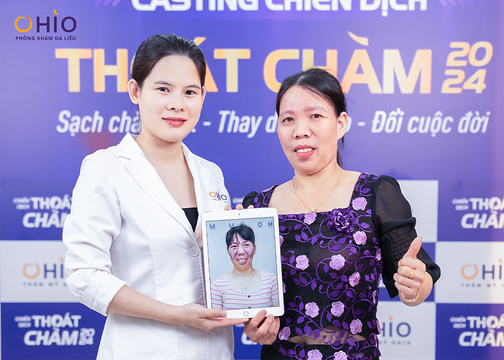 XÓA CHÀM BỚT VÙNG MẶT BẰNG PHƯƠNG PHÁP NÀO HIỆU QUẢ? - Phòng khám da liễu OHIO XÓA CHÀM BỚT VÙNG MẶT BẰNG PHƯƠNG PHÁP NÀO HIỆU QUẢ?