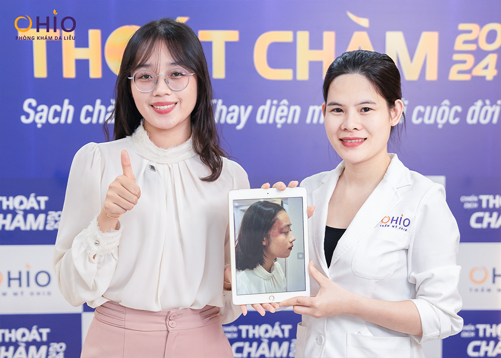 Bớt rượu vang, bớt đỏ u máu, chàm bớt đỏ là gì? và những điều lưu ý - Phòng khám da liễu OHIO Bớt rượu vang, bớt đỏ u máu, chàm bớt đỏ là gì? và những điều lưu ý