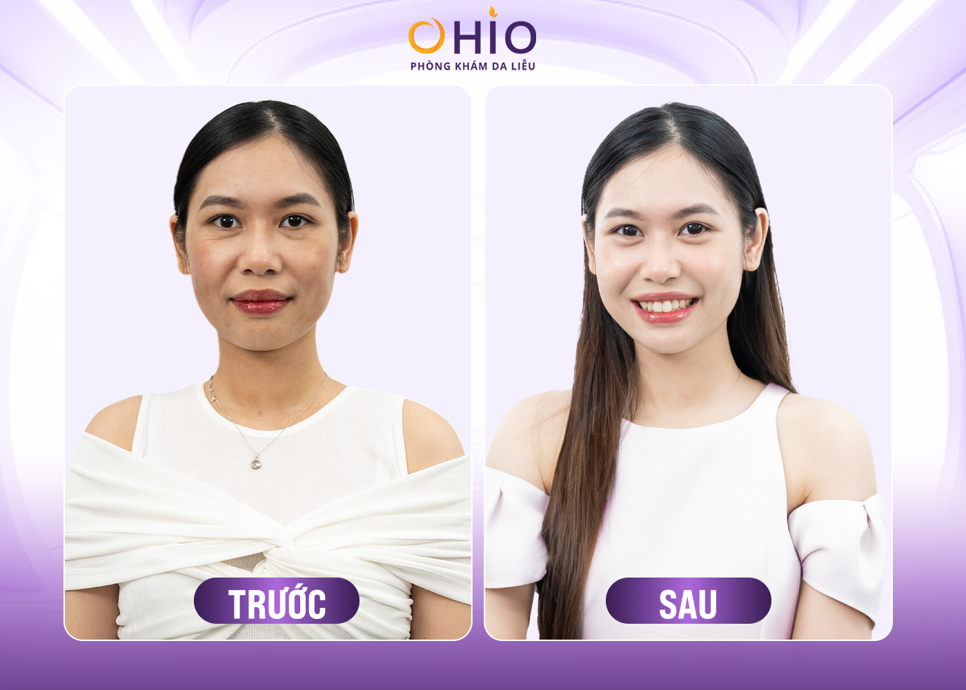 Công Nghệ Trẻ Hóa Da Ultherapy - Giải Pháp Nâng Cơ Không Phẫu Thuật - Phòng khám da liễu OHIO Khách hàng điều trị trẻ hóa bằng công nghệ
