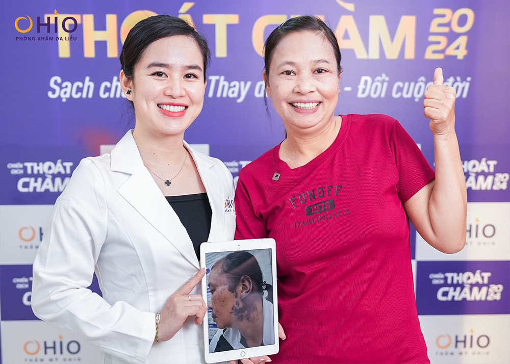 Bớt rượu vang, bớt đỏ u máu, chàm bớt đỏ là gì? và những điều lưu ý - Phòng khám da liễu OHIO Bớt rượu vang, bớt đỏ u máu, chàm bớt đỏ là gì? và những điều lưu ý