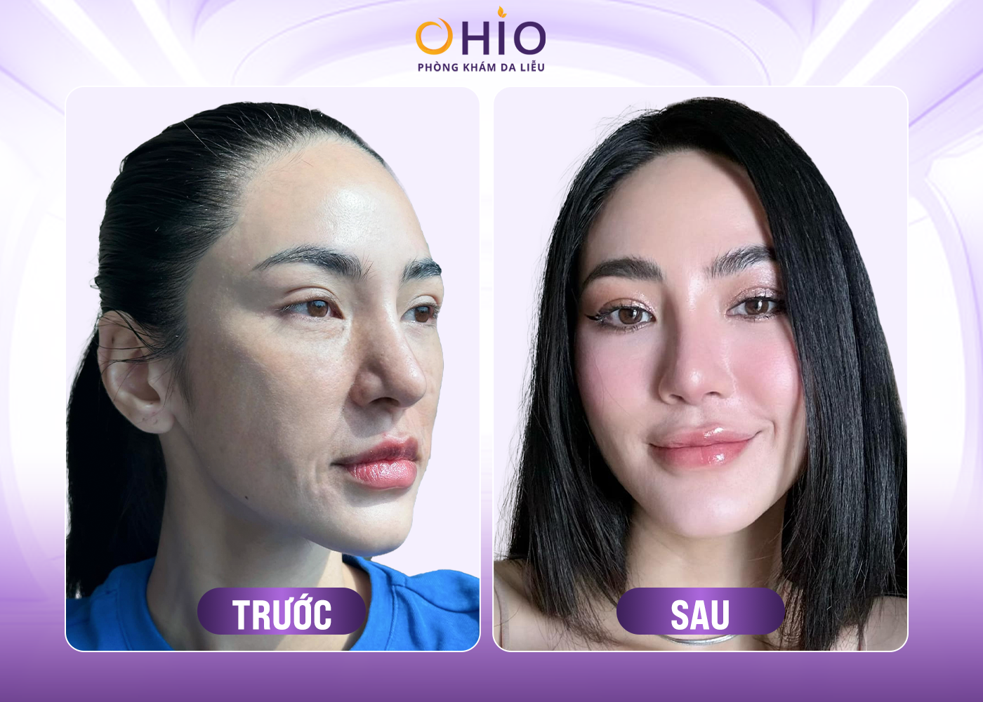 Công Nghệ Trẻ Hóa Da Ultherapy - Giải Pháp Nâng Cơ Không Phẫu Thuật - Phòng khám da liễu OHIO hình ảnh trẻ hóa bằng công nghệ Ultherapy