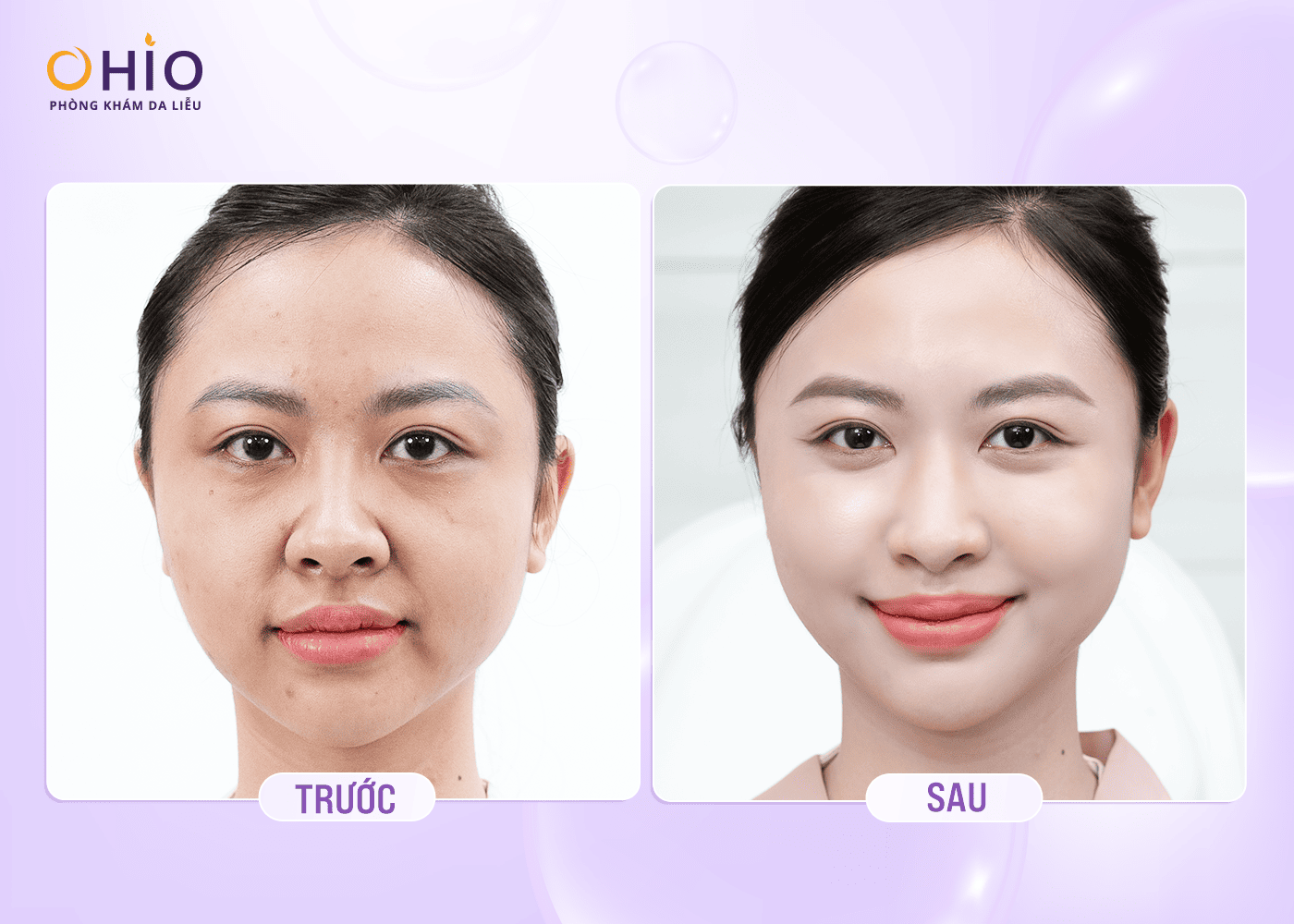 Phác Đồ Trẻ Hóa Da Đa Điểm Reborn Lift - Tái Sinh Nguyên Bào Thế Hệ Mới - Phòng khám da liễu OHIO Reborn Lift