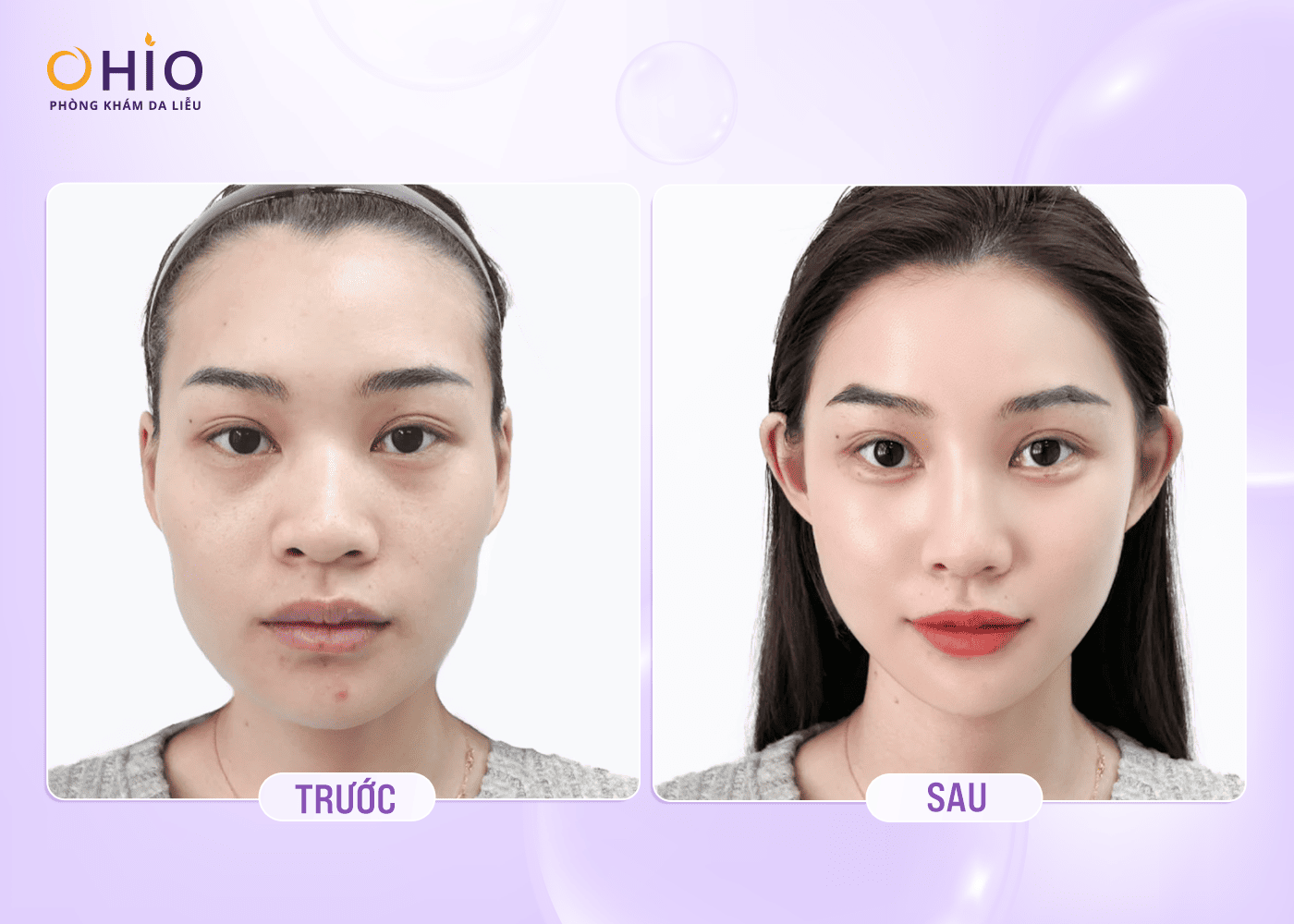 Phác Đồ Trẻ Hóa Da Đa Điểm Reborn Lift - Tái Sinh Nguyên Bào Thế Hệ Mới - Phòng khám da liễu OHIO trẻ hoá da