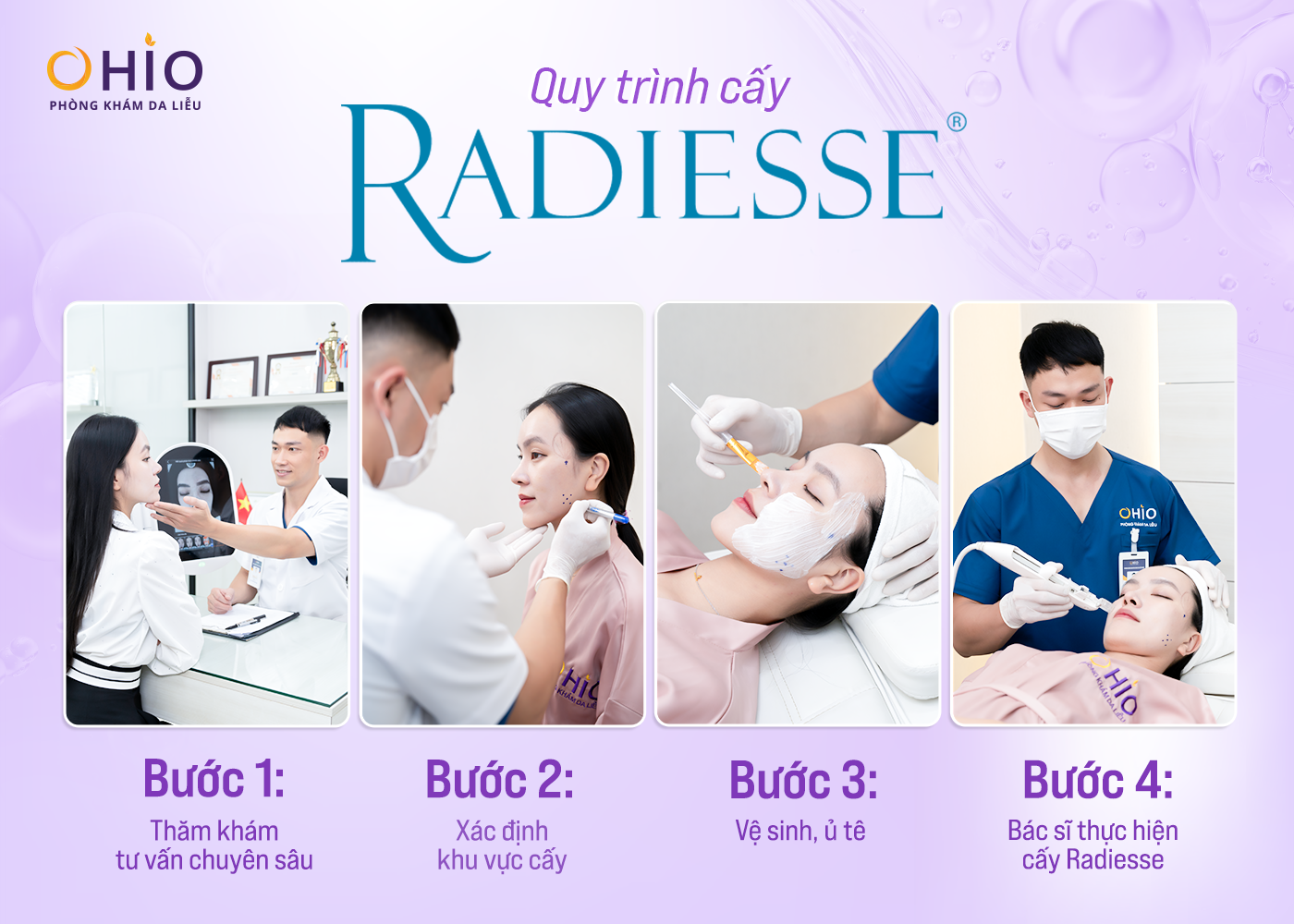 Radiesse – Chất Làm Đầy Thế Hệ Mới Giúp Trẻ Hóa Da Hiệu Quả và Lâu Dài - Phòng khám da liễu OHIO Radiesse – Chất Làm Đầy Thế Hệ Mới Giúp Trẻ Hóa Da Hiệu Quả và Lâu Dài