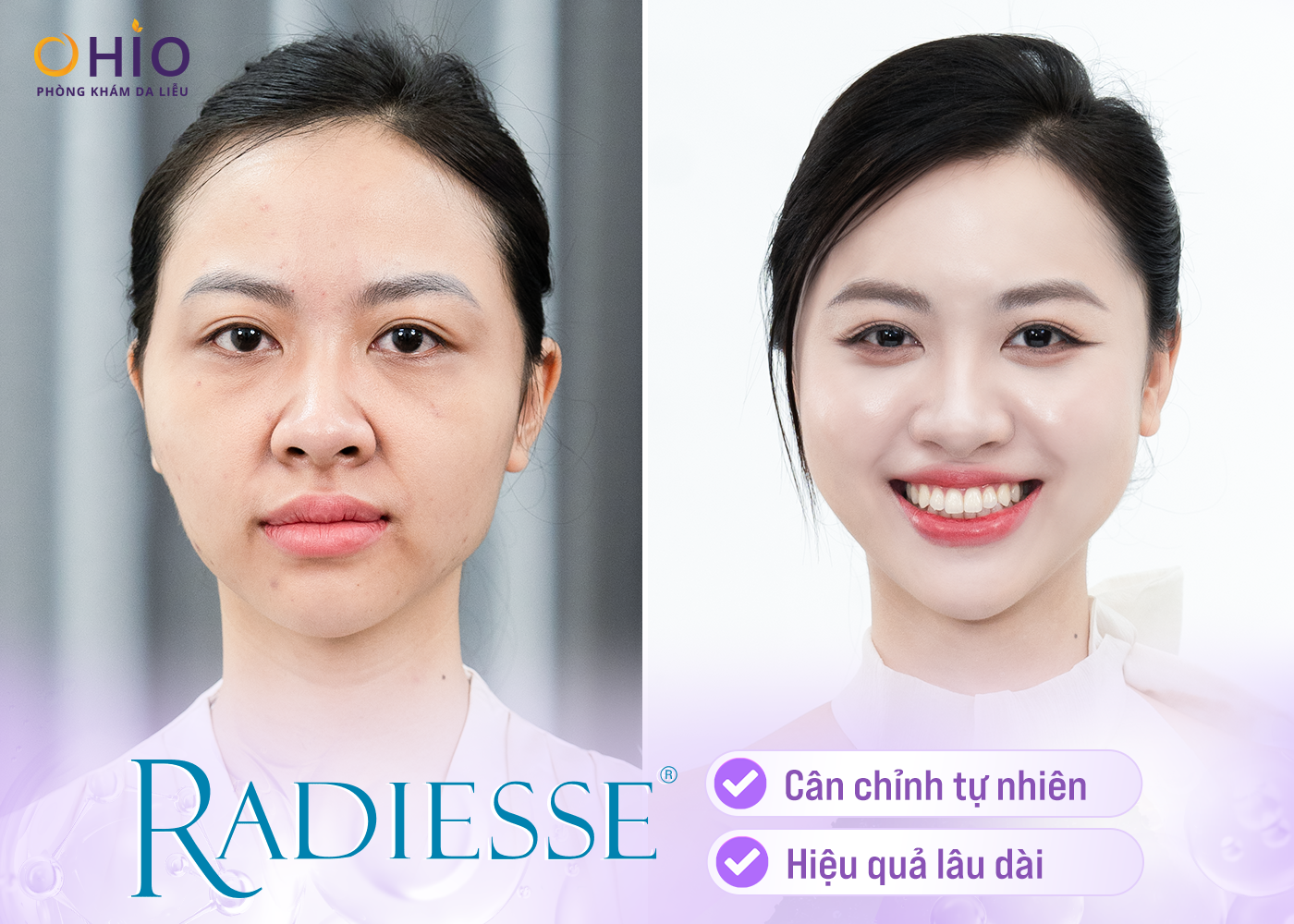 Radiesse – Chất Làm Đầy Thế Hệ Mới Giúp Trẻ Hóa Da Hiệu Quả và Lâu Dài - Phòng khám da liễu OHIO Radiesse – Chất Làm Đầy Thế Hệ Mới Giúp Trẻ Hóa Da Hiệu Quả và Lâu Dài