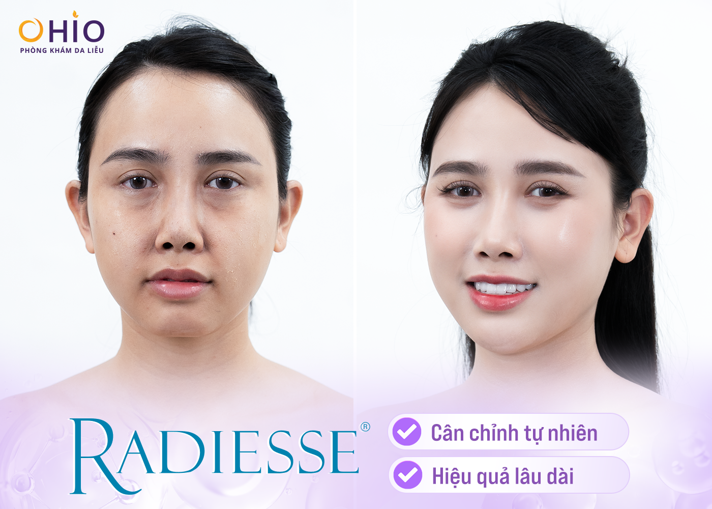 Radiesse – Chất Làm Đầy Thế Hệ Mới Giúp Trẻ Hóa Da Hiệu Quả và Lâu Dài - Phòng khám da liễu OHIO Radiesse – Chất Làm Đầy Thế Hệ Mới Giúp Trẻ Hóa Da Hiệu Quả và Lâu Dài