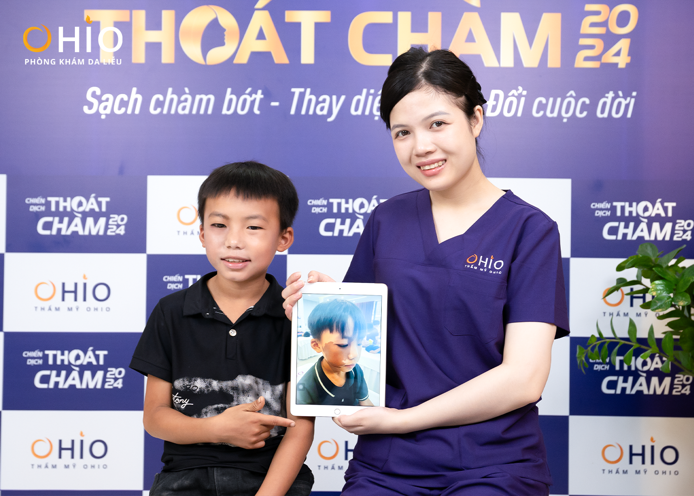 XÓA CHÀM BỚT VÙNG MẶT BẰNG PHƯƠNG PHÁP NÀO HIỆU QUẢ? - Phòng khám da liễu OHIO XÓA CHÀM BỚT VÙNG MẶT BẰNG PHƯƠNG PHÁP NÀO HIỆU QUẢ?
