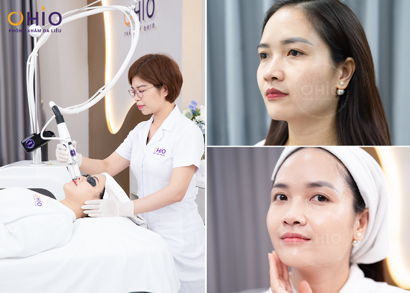 Chi phí điều trị Giãn mao mạch Mũi năm 2025 - Phòng khám da liễu OHIO Chi phí điều trị Giãn mao mạch Mũi năm 2025