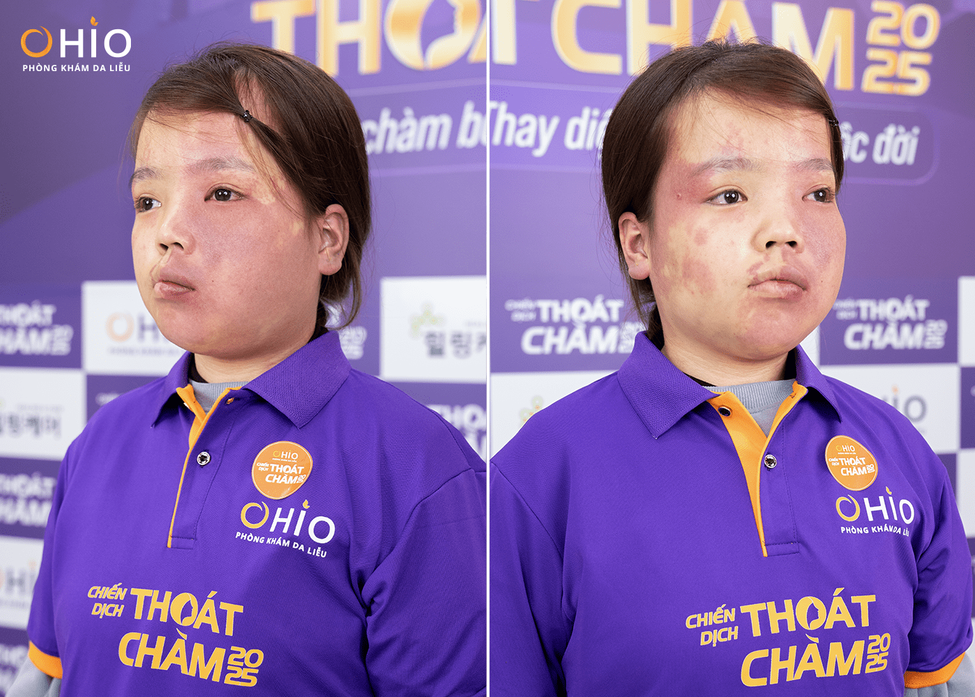 Hàng trăm hồ sơ đăng ký casting chiến dịch "Thoát chàm 2025", những câu chuyện lay động – Những gương mặt đầu tiên lộ diện - Phòng khám da liễu OHIO thoát chàm 2025