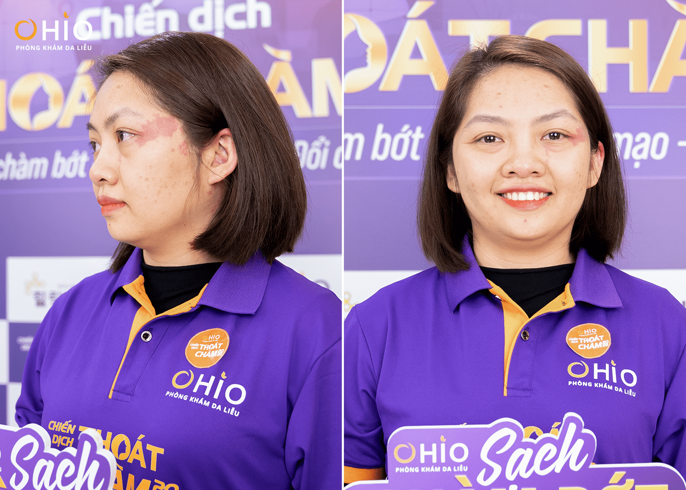 Hàng trăm hồ sơ đăng ký casting chiến dịch "Thoát chàm 2025", những câu chuyện lay động – Những gương mặt đầu tiên lộ diện - Phòng khám da liễu OHIO Hàng trăm hồ sơ đăng ký casting chiến dịch "Thoát chàm 2025", những câu chuyện lay động – Những gương mặt đầu tiên lộ diện