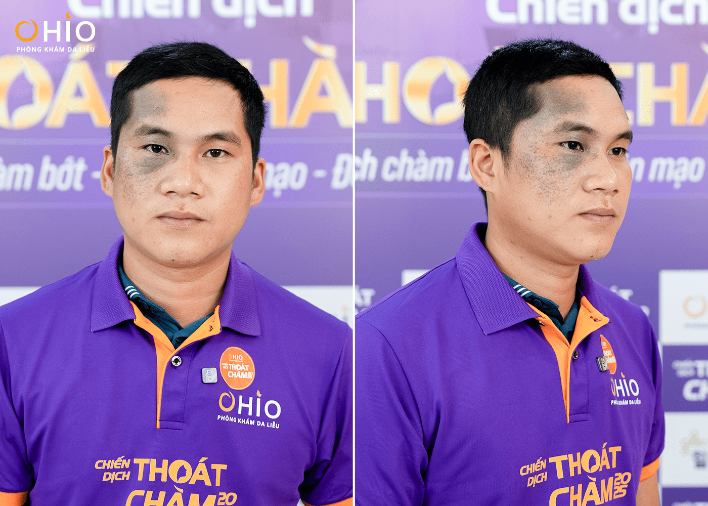 Hàng trăm hồ sơ đăng ký casting chiến dịch "Thoát chàm 2025", những câu chuyện lay động – Những gương mặt đầu tiên lộ diện - Phòng khám da liễu OHIO Hàng trăm hồ sơ đăng ký casting chiến dịch "Thoát chàm 2025", những câu chuyện lay động – Những gương mặt đầu tiên lộ diện