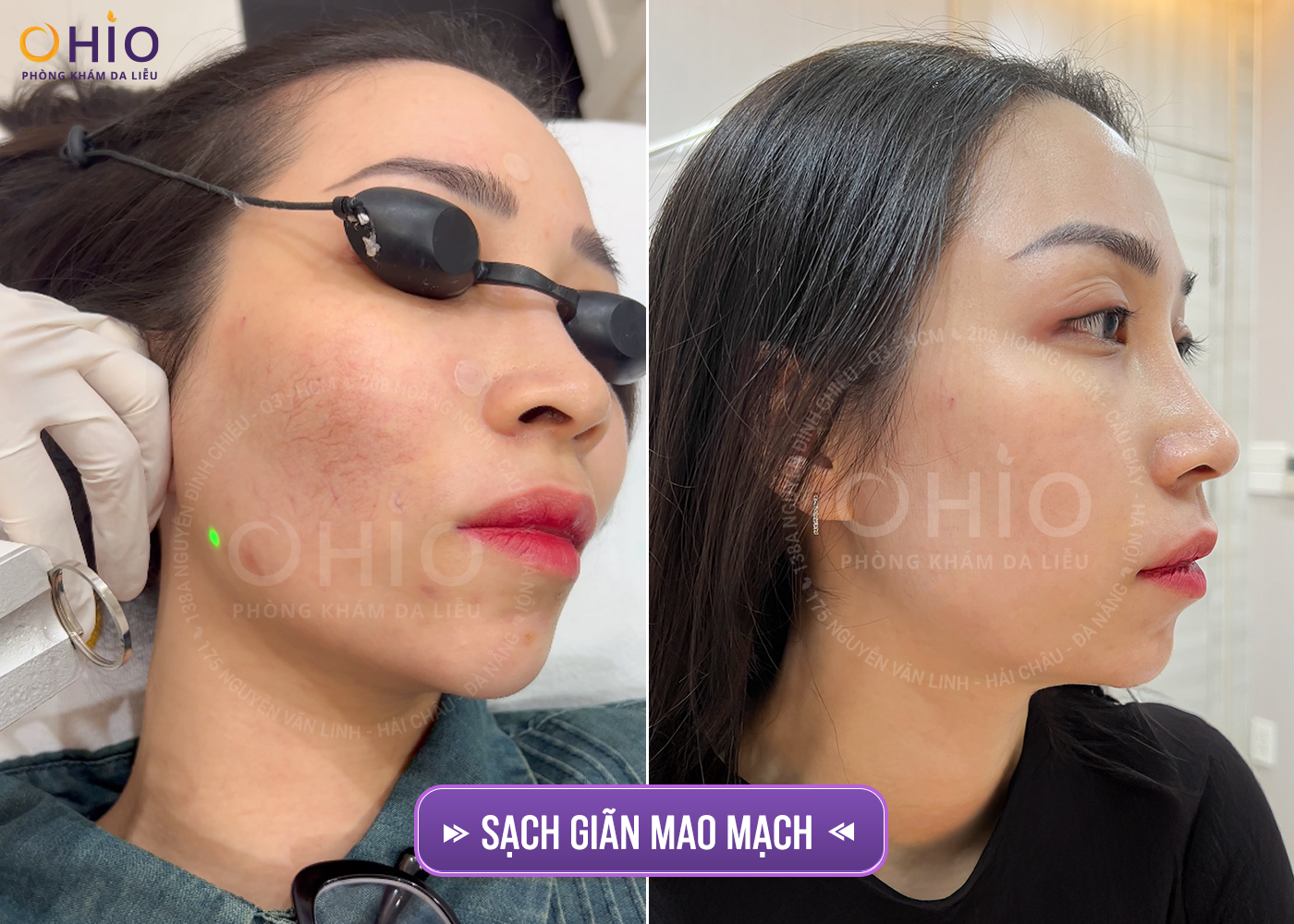 WOMEN SHINE - Đẹp tỏa sáng: Ngập tràn ưu đãi tại phòng khám da liễu OHIO