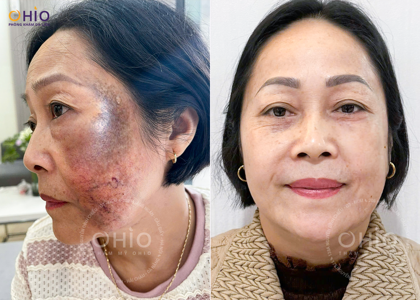 Lễ Kickoff Chiến dịch Thoát Chàm 2025 - Chính thức khởi động hành trình sạch chàm bớt thay diện mạo, đổi cuộc đời - Phòng khám da liễu OHIO Lễ Kickoff Chiến dịch Thoát Chàm 2025 - Chính thức khởi động hành trình sạch chàm bớt thay diện mạo, đổi cuộc đời