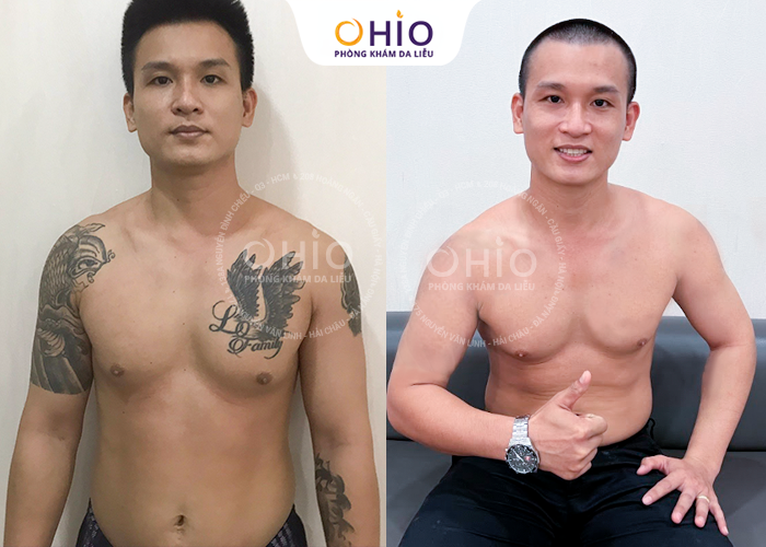 Địa chỉ xóa hình xăm ở Hà Nội