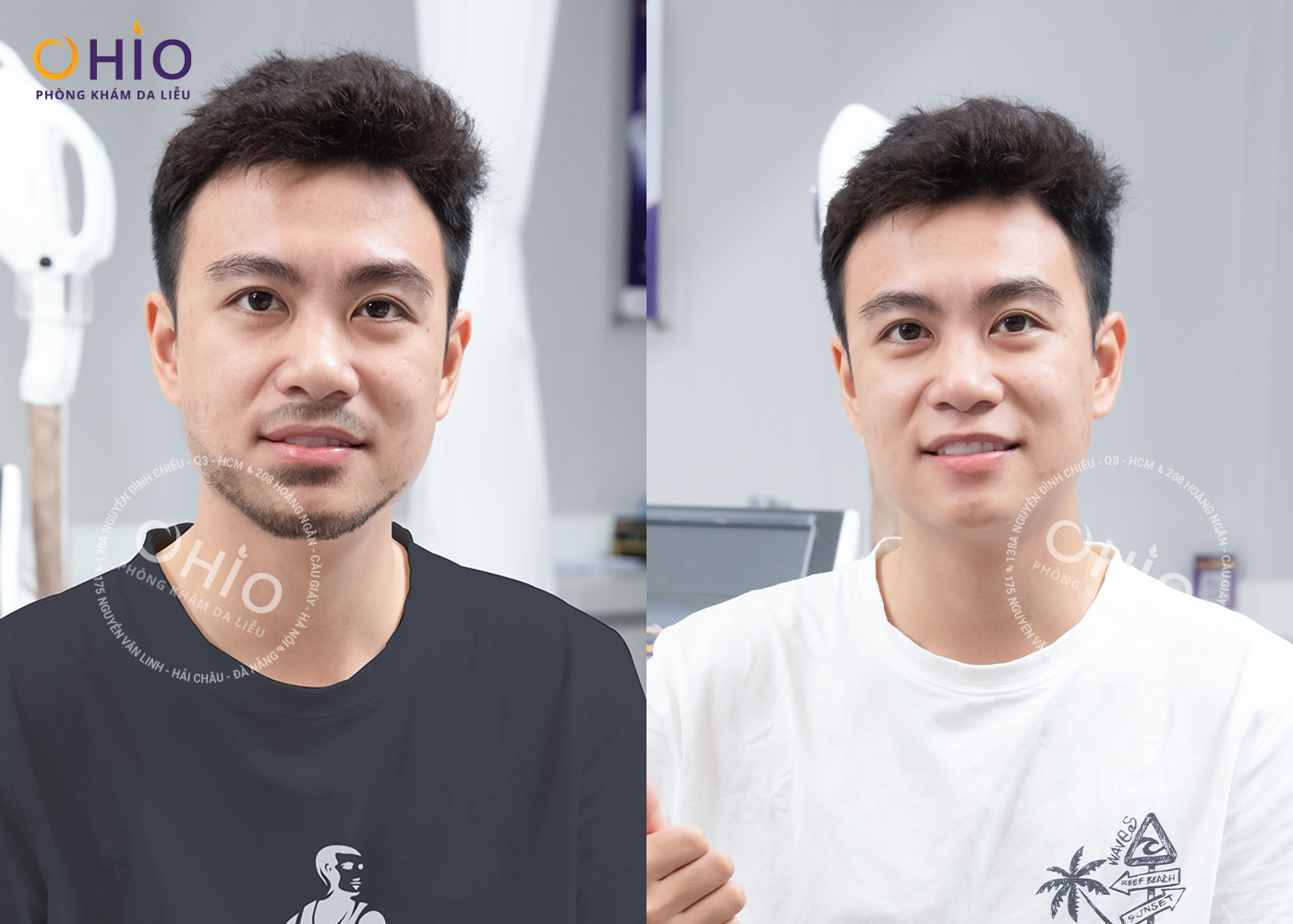 TRIỆT RÂU QUAI NÓN, CỨNG RẬM GIÁ BAO NHIÊU ? - Phòng khám da liễu OHIO TRIỆT RÂU QUAI NÓN, CỨNG RẬM GIÁ BAO NHIÊU ?