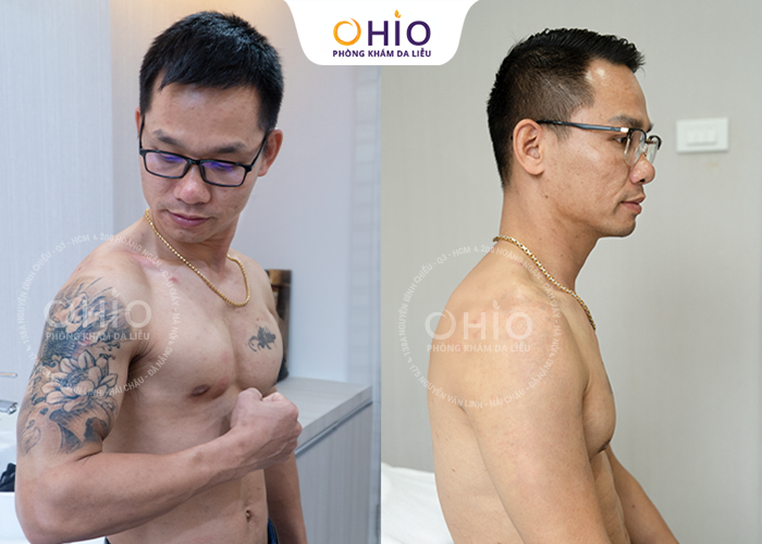 ĐỊA CHỈ XÓA XĂM UY TÍN TẠI TP HCM SỬ DỤNG CÔNG NGHỆ TIÊN TIẾN