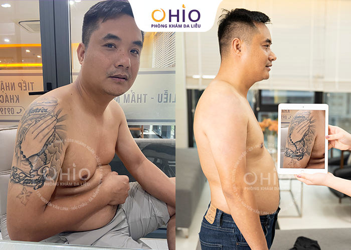 Xóa xăm Piconew 450 - Công nghệ xóa xăm tại phòng khám OHIO